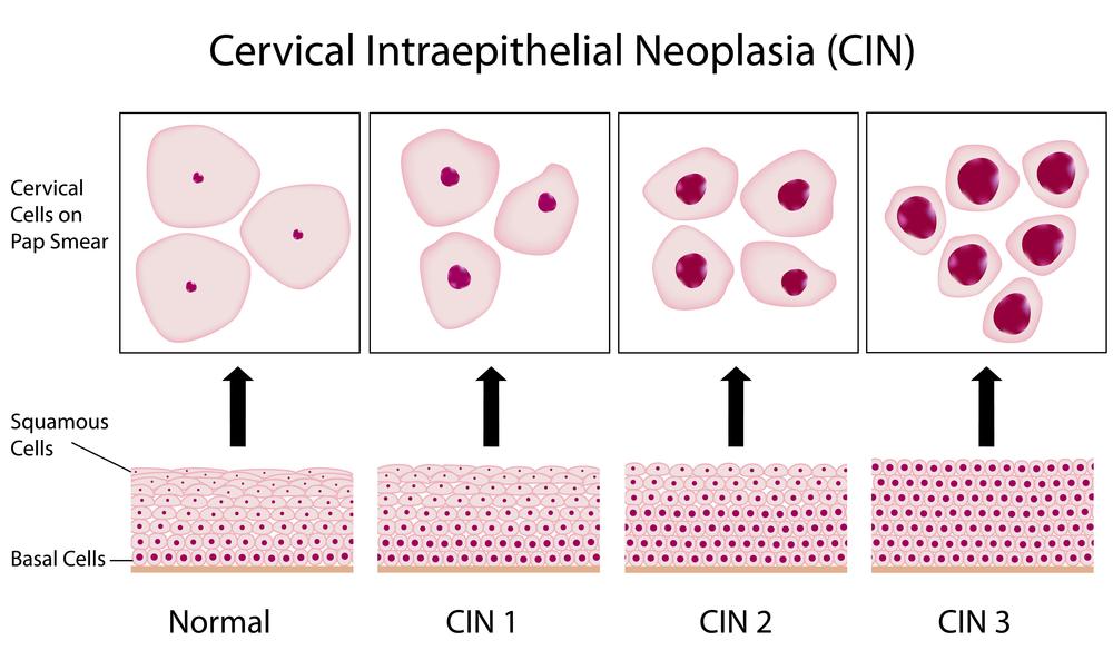 An overview about pap smear tests