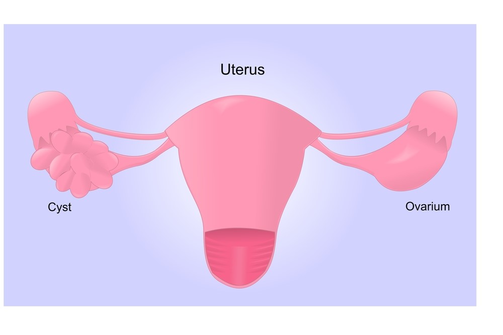 Symptoms and types of ovarian cysts