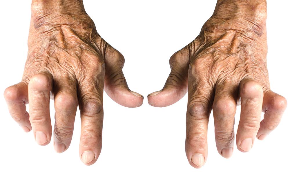 The Common Signs and Symptoms of Rheumatoid Arthritis